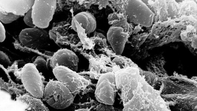 Apa Itu Penyakit Pneumonia?