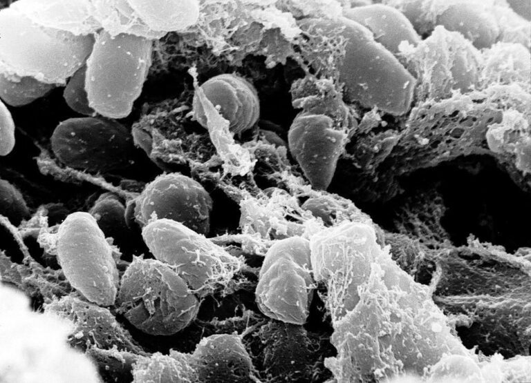 Apa Itu Penyakit Pneumonia?